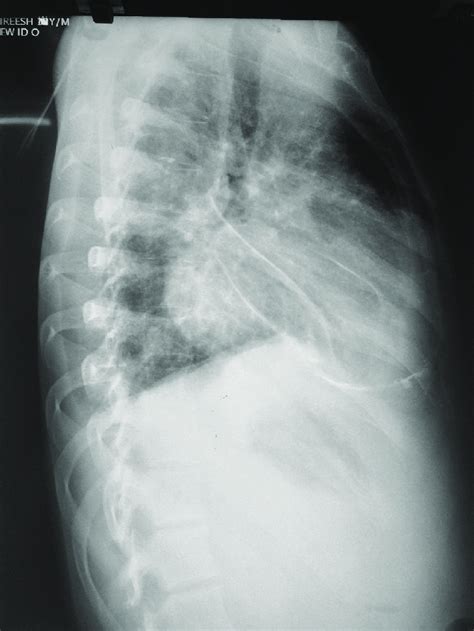 Chest X-ray lateral view | Download Scientific Diagram