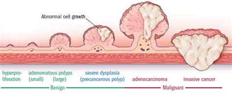 They found colon polyps: Now what? - Harvard Health