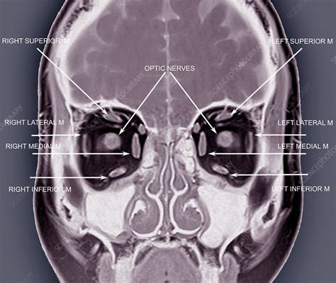 Eye anatomy and muscles, MRI scan - Stock Image C033/7451 - Science ...