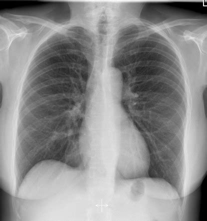 Chest radiograph | Radiology Reference Article | Radiopaedia.org