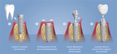 Dental Implants - Chandler Family Dentistry