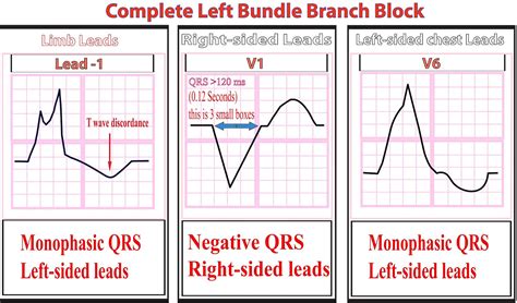 Ekg Bundle Branch Block Identification