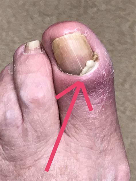 Infected toenail or nail fungus? – Dr. Nicholas Campitelli