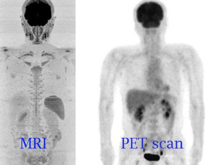 Comparison Of Pet And Mri Scan | Hot Sex Picture