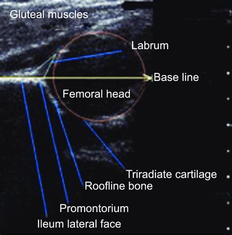 Anterior Hip Joint Ultrasound