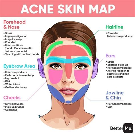 Proskin Aesthetics on Instagram: "THIS IS WHAT ACNE SAYS ABOUT YOUR HEALTH👆🏻👁 Where do you ...