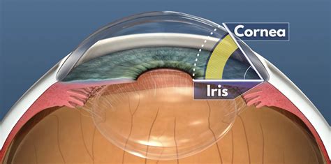 Laser Peripheral Iridotomy - Treat Angle-Closure Glaucoma | Dr Nathan Kerr