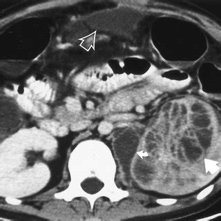 Cranial tuberculomas. Axial contrastenhanced CT scan demonstrates ...