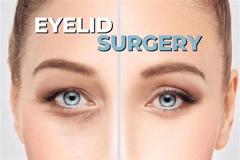 The Risks and Benefits of Eyelid Surgery - EZOnTheEyes