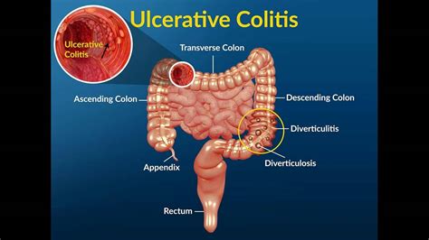 Mucus in Stool The Best Treatment Options english - YouTube