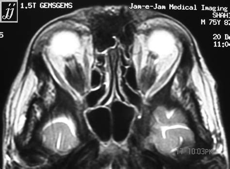 Optic nerve sheet tumor – Radiopaedia