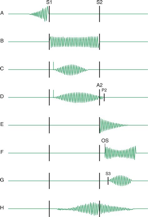 Heart Murmur Diagram Heart Murmurs — Take Aurally