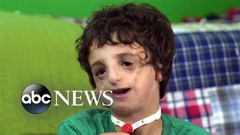 Boy living with Treacher Collins has 53 surgeries by age 11: 20/20 Part ...