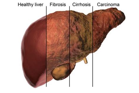 Liver fibrosis may occur in teens with chronic HCV infection | Latest news for Doctors, Nurses ...