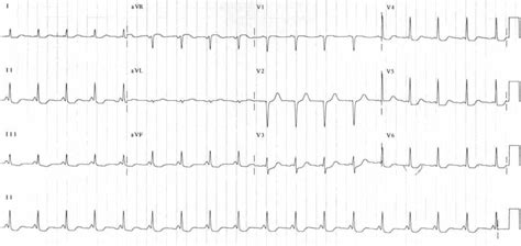 PR Interval • LITFL • ECG Library Basics