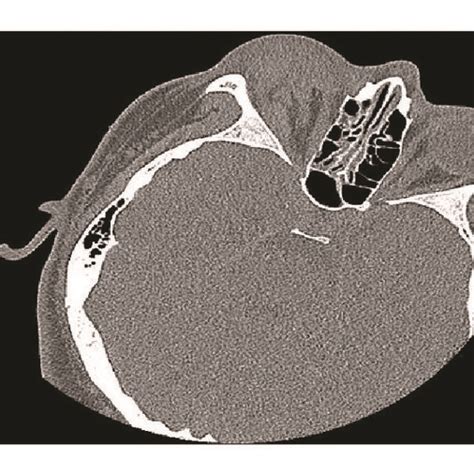 Right globe rupture on nonenhanced CT scan of the orbits. | Download Scientific Diagram