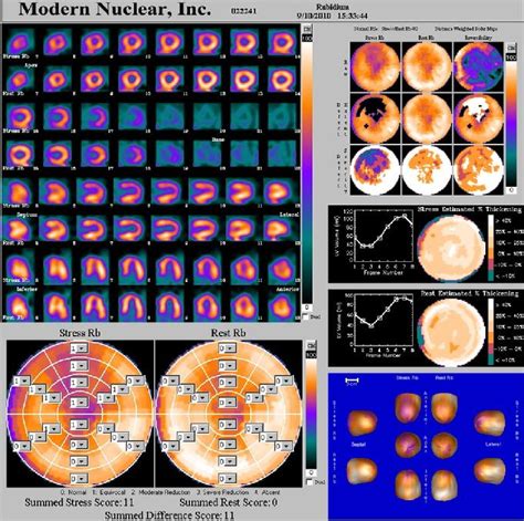 Cardiac PET Scan Long Island, New york