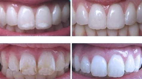 How To Remineralize And Regrow Tooth Enamel Naturally! | Tooth enamel, Remineralize teeth, Tooth ...