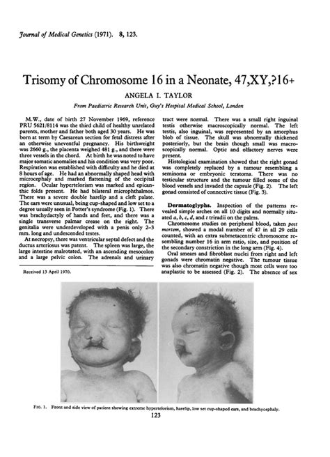 Trisomy of chromosome 16 in a neonate, 47XY,?16+. | Journal of Medical ...