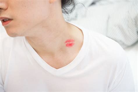 How to Get Rid of a Hickey - Facty