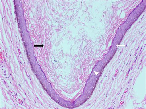 Pilar Cyst Histology