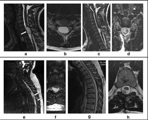 Spinal Arachnoid Cyst Surgery Recovery Time - mapayakusa