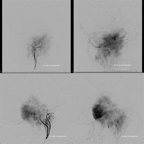 Case Archives Petroclival Meningioma MHT and ILT access | neuroangio.org