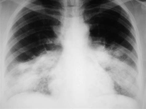 mycoplasma pna - pictures, photos