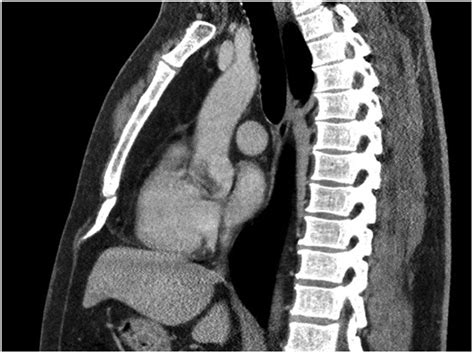 Xiphoid Process Protruding