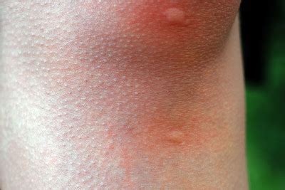 Bug Bites We Can Treat at Helendale Dermatology | Rochester NY