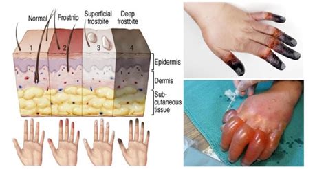 Frostbite - Causes, Prevention, Signs, Symptoms & Frostbite Treatment