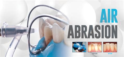 Air Abrasion - Optident - Specialist Dental Products and Courses