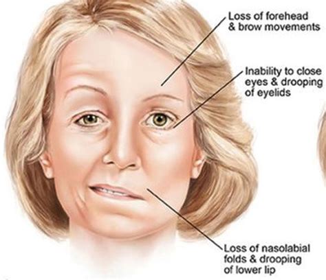 Facial Palsy – St Mark Rehab | Physical Therapy Outpatient Clinic