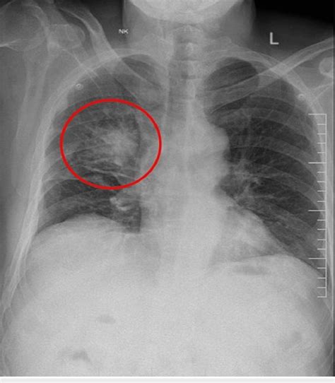 Chest X-ray PA view showing an ill-defined spiculated opacity in the... | Download Scientific ...