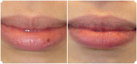 Freckle On Lip Removal | Sitelip.org