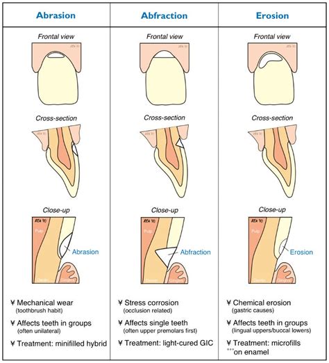 What is the difference between dental attrition, abfraction, erosion ...