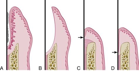 61: Periodontal Regeneration and Reconstructive Surgery | Pocket Dentistry