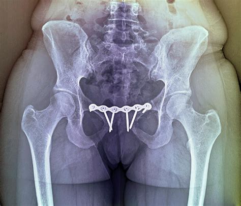 'pinned Pelvic Fracture Photograph by Zephyr/science Photo Library