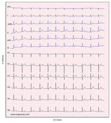 What Is Normal Avl In Ecg at Maude Utley blog