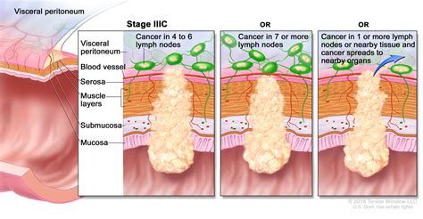 Colon Cancer Treatment (PDQ®) - NCI