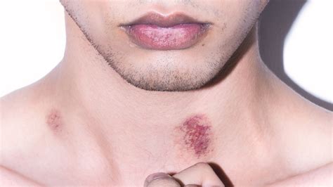 How to get rid of a hickey, if you somehow are still getting hickeys | British GQ | British GQ