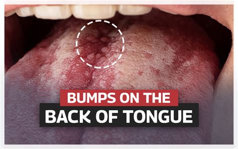 Bumps On The Back Of The Tongue | Causes, Treatment & Prevention