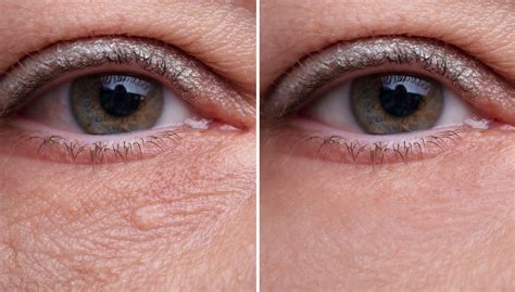 How to Treat Under Eye Bags and Wrinkles - DiscoverHealth