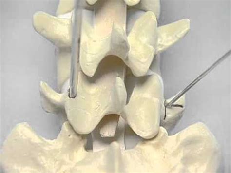 Pedicle Identification_spine surgery - YouTube