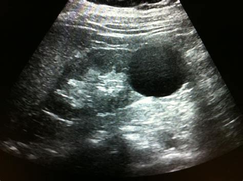 Renal Cyst Archives - UCSD Ultrasound