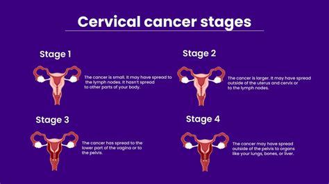 Different Stages Of Cervical Cancer