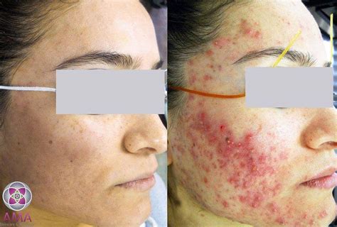 Laser Treatment for Acne Scars