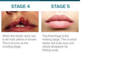 Cold Sore Stages: Identification and Treatment