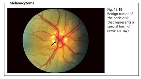 Intraocular Optic Nerve Tumors