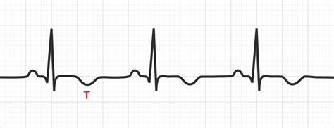 T Wave Inversion | Test Findings - MedSchool